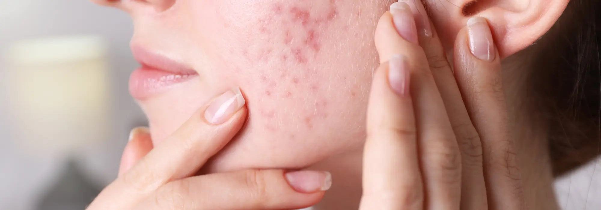 Quelles-sont-les-causes-d-un-bouton-sur-le-visage Mundo Image