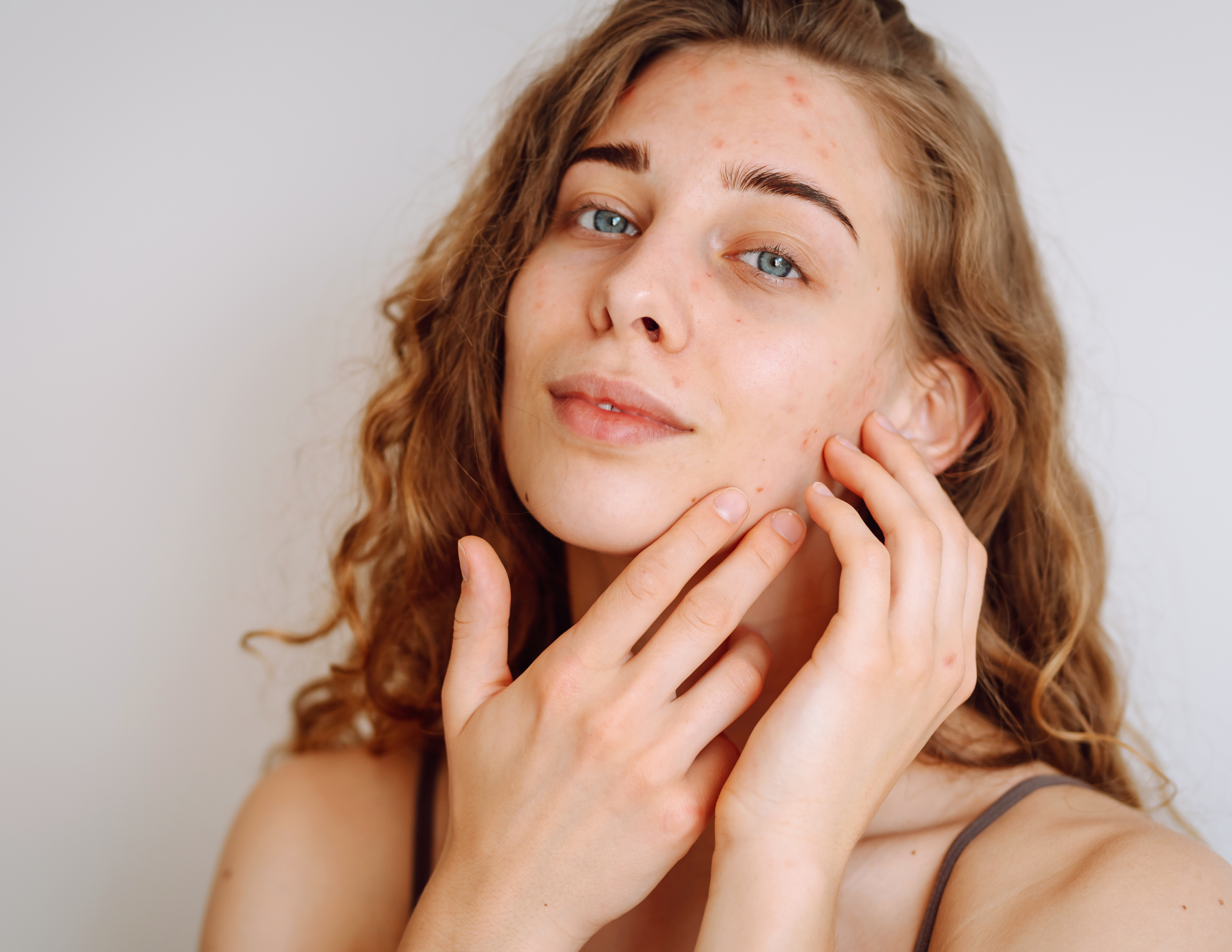 Image d'une jeune fille montrant sa peau qui présente quelques imperfections (acnès, bouton, point noir)